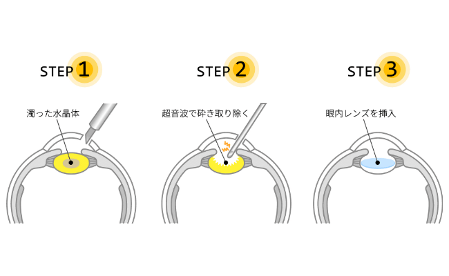 眼内レンズイメージ