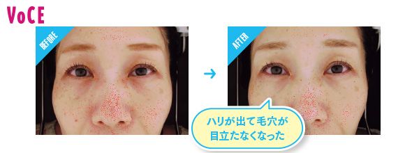 BEFORE→AFTER ハリが出て毛穴が目立たなくなった