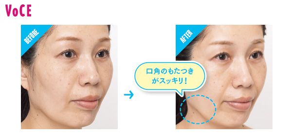 BEFORE→AFTER 口角のもたつきがスッキリ！