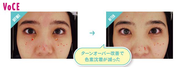 BEFORE→AFTER ターンオーバー改善で色素沈着が減った