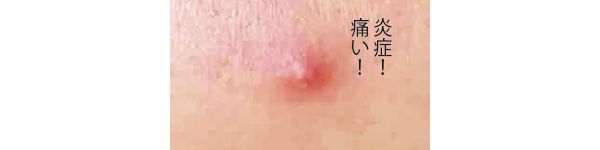 赤ニキビ 炎症！ 痛い！