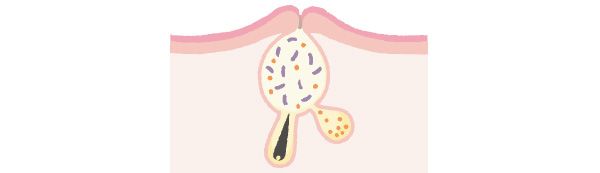 毛穴の奥には皮脂腺が存在しているため、ふさがれた毛穴の内部に皮脂が詰まり、白ニキビに。