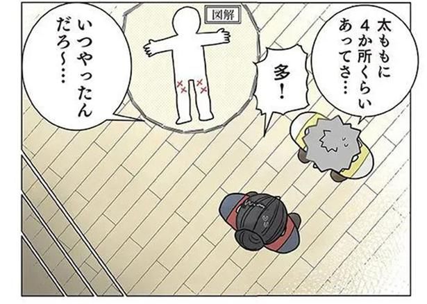 こんなところになぜ？ 保育士の太ももに4か所もアザができていたワケ （C）でこぽん吾郎／KADOKAWA