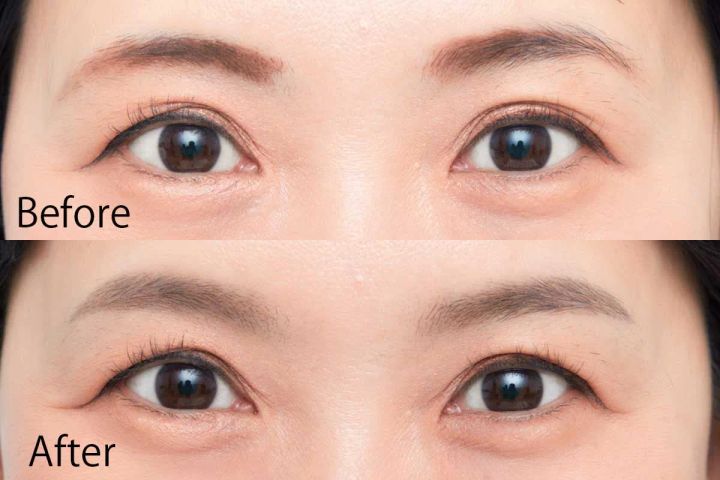 左右非対称眉 ビフォーアフター