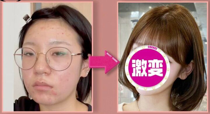 【写真・画像】ニキビ顔→肌治療＆メイク術でアイドルになった美女、ビフォーアフターに驚きの声 1枚目