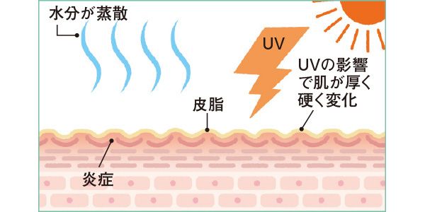 水分が蒸散 UV 皮脂 UVの影響で肌が厚く硬く変化 炎症