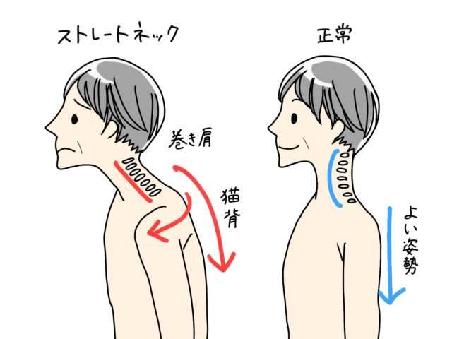 猫背・巻き肩・ストレートネック