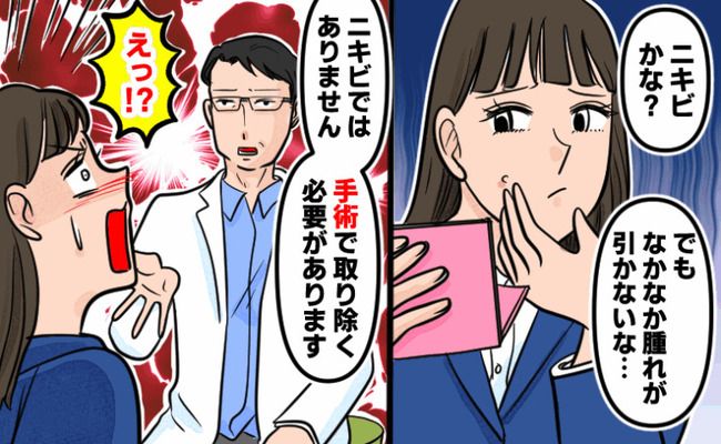 粉瘤 イメージカット