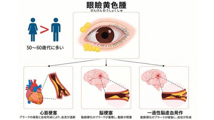 眼瞼黄色腫（がんけんおうしょくしゅ）は他の病とかかわっている