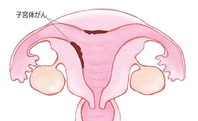 閉経・肥満・未産が高リスク！50代に急増する「子宮体がん」の見逃しがちな症状は？【医師監修】