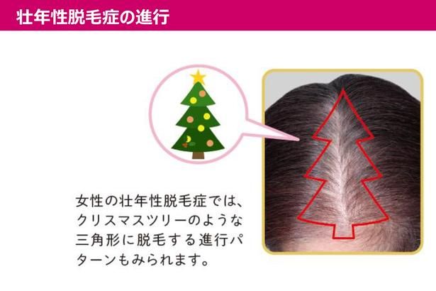 女性の壮年性脱毛症 大正製薬株式会社