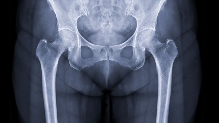 たった1度の点滴で骨折は94％減少、骨強度も増加