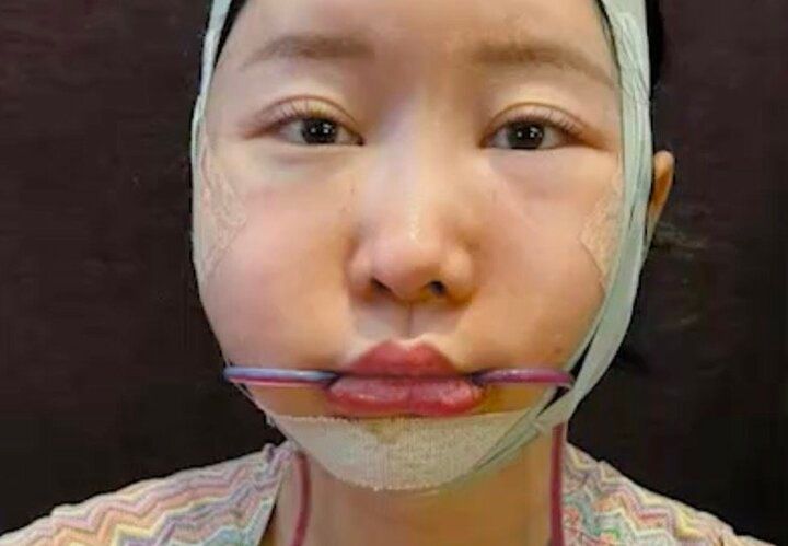 【写真・画像】「骨切り3点」で小顔整形…整形総額1500万円・シンママ美女、ダウンタイム中の写真を公開「ご飯食べれないし、口も全く開かない。しばらくは注射器で流動食」 1枚目