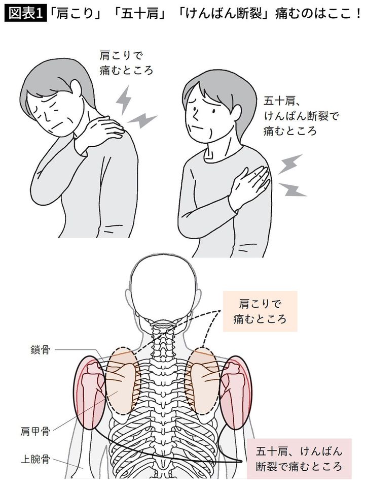 「肩こり」「五十肩」「けんばん断裂」痛むのはここ！