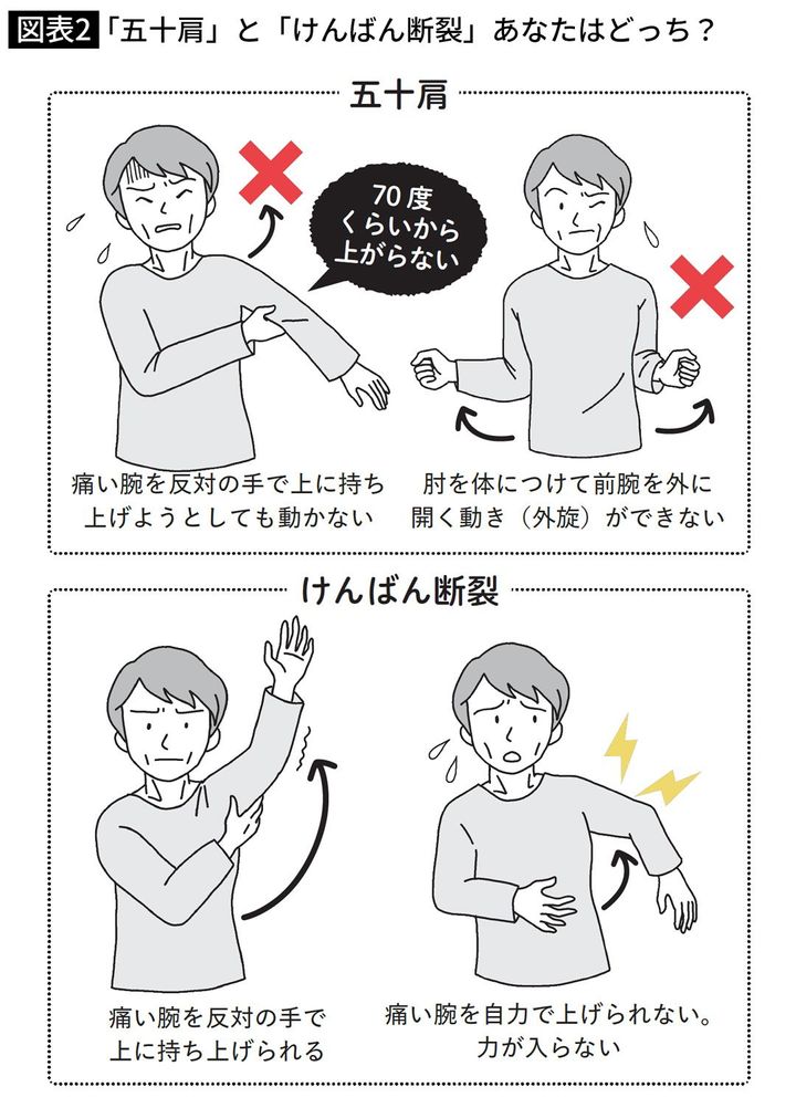 「五十肩」と「けんばん断裂」あなたはどっち？