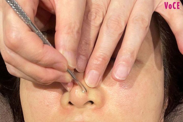 新鮮な痛みに涙目に！ 黒ずみ毛穴が目立たなくなって感動！