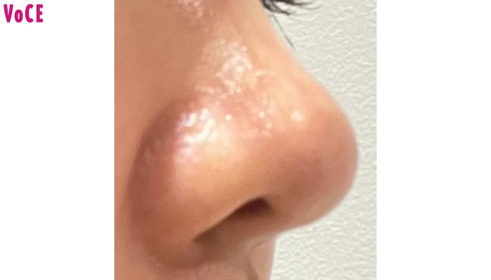 渋谷スキンクリニックでは「コメド圧出」が990円で受けられます