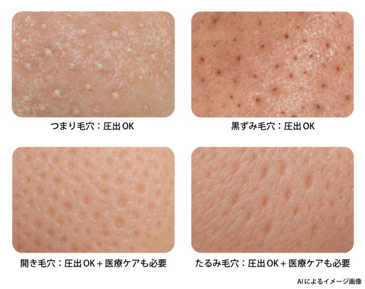 毛穴＆ニキビの状態別に解説・圧出はOK or NG？