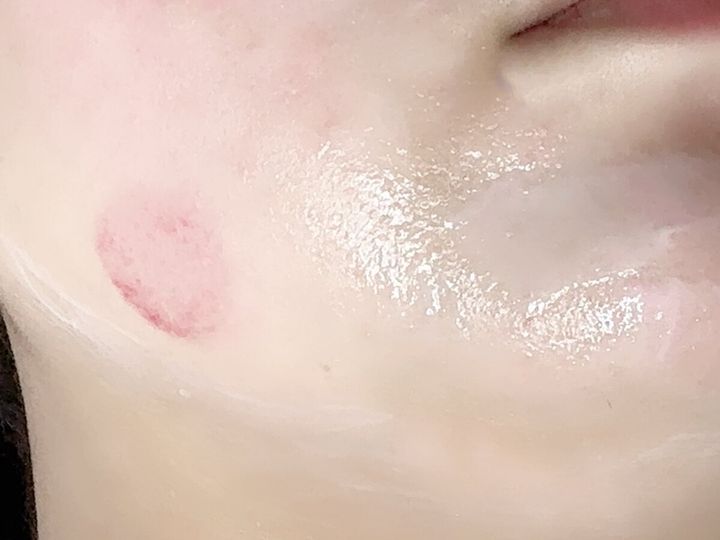 フェイシャルカッピングカップ使用後の女性の頬。吸着による丸い赤みが見える。