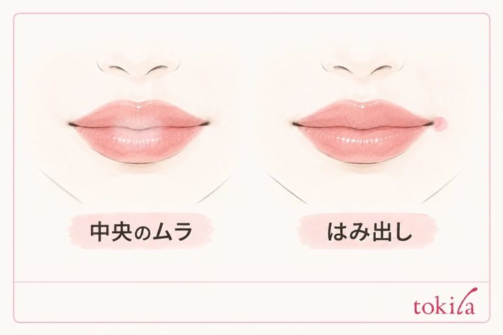 唇中央のムラと口角のはみ出しを分ける模式図