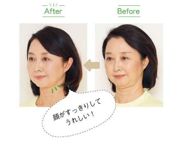 すっきり！目も大きく開くようになりました