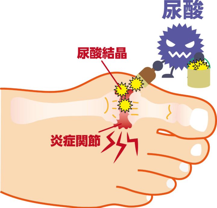 痛風とは？