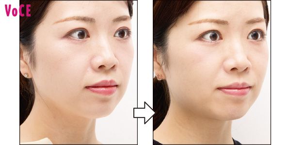 ほうれい線の影が短く。リフトアップ実感に驚き