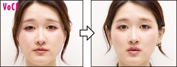 頰の位置が上がり、フェイスラインもすっきり
