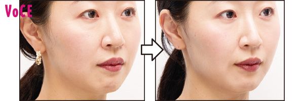 パンッとしたハリが出て、フェイスラインがくっきり