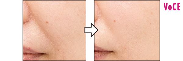 キメが整い、ふっくら！ ほうれい線の影にも変化