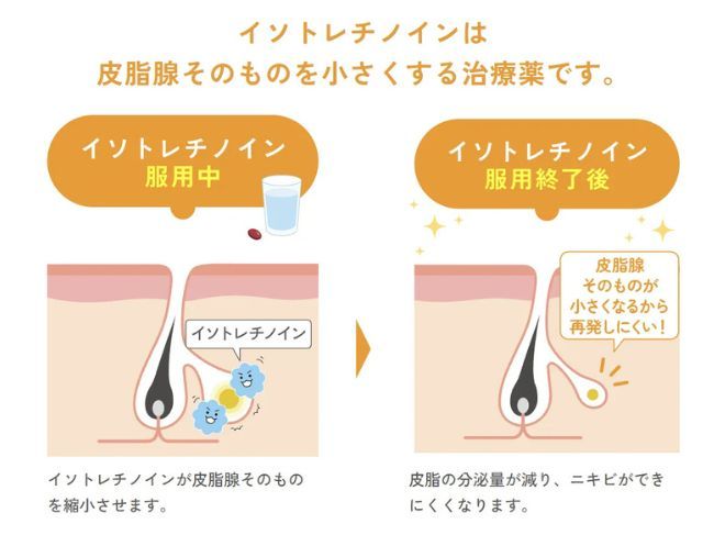 イソトレチノイン治療とは