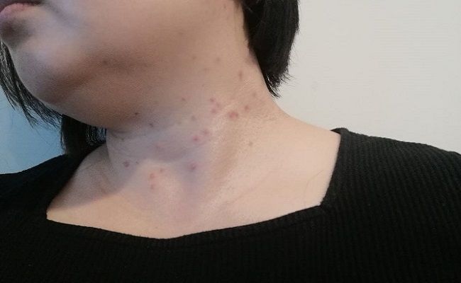 首元のイボのイメージ（筆者撮影）
