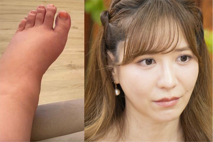 【写真・画像】「MAX体重75キロ」元国民的アイドル（34）、妊娠＆出産で激太り「空気吸ってても太った」当時の写真を公開 1枚目