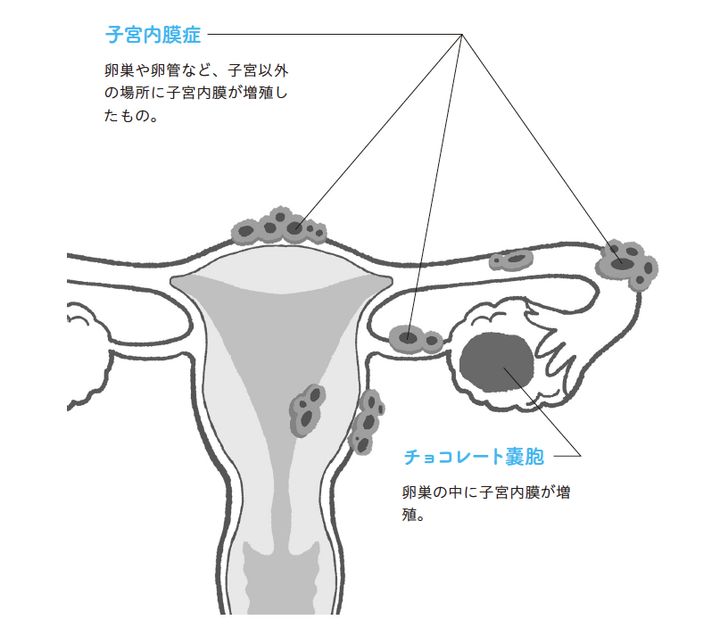 子宮内膜症