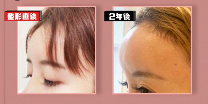 【写真・画像】「鼻先の軟骨が飛び出そうに」鼻整形を5回した美女、整形失敗写真を公開「皮膚突き破りそう」驚きの声 1枚目